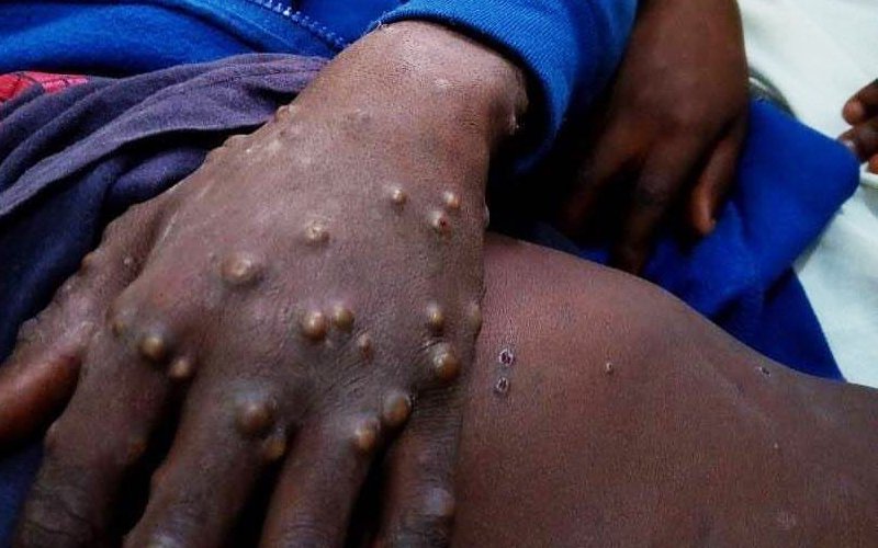 L’hôpital général de référence de Kinshasa signale un cas de Monkey pox parmi ses patients